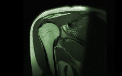 IRM Epaule – Arthro IRM