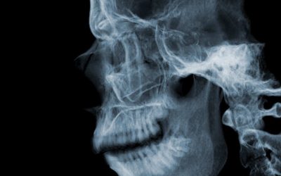 Scanner crâne; sinus, rochers (oreilles)