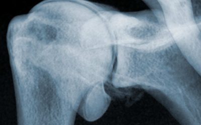 Arthroscanner de l’épaule