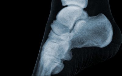 angiographie des membres inférieurs