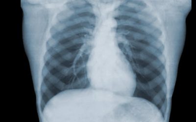 Scanner thorax/abdomen/pelvis (TAP)