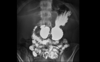 Transit oesophagien et gestro-duodénal (TOGD)